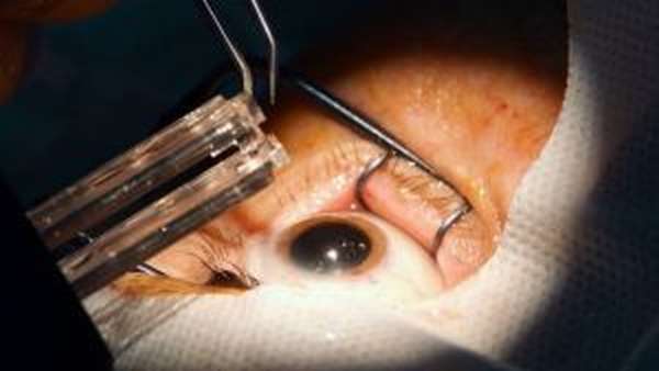 офтальмологическая операция